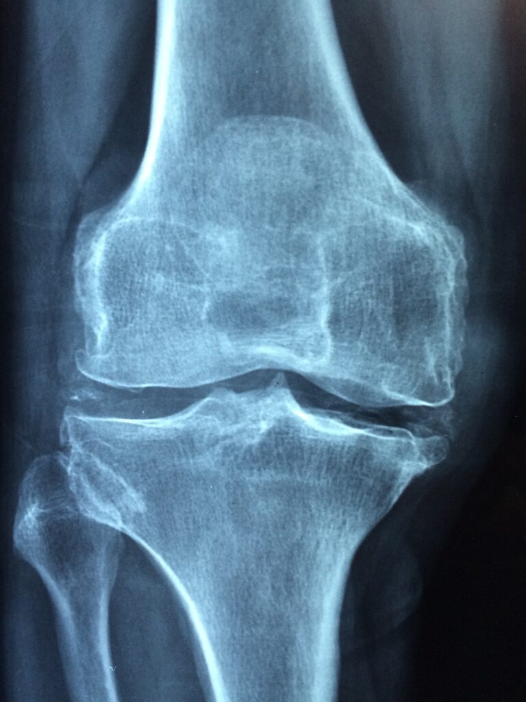 X-ray image displaying an injury, highlighting the medical consequences of being struck by a falling object and the need for a falling object lawyer to help recover as many damages as possible.